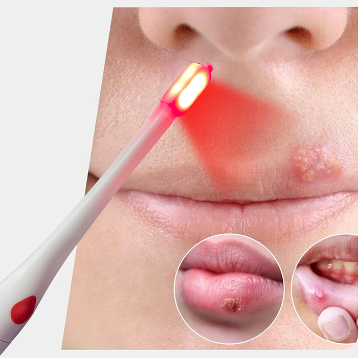 SOREAID cold sore treatment device